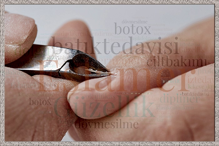 Batık Tırnak Tedavisi